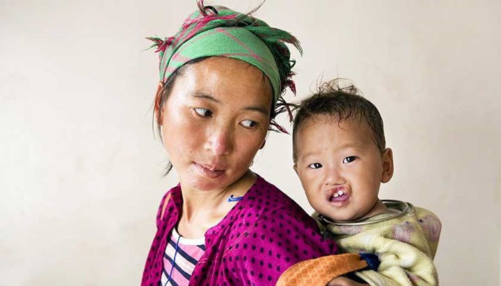 Operation Smile verhilft Kindern mit Gesichtsfehlbildungen zu einem neuen Start ins Leben